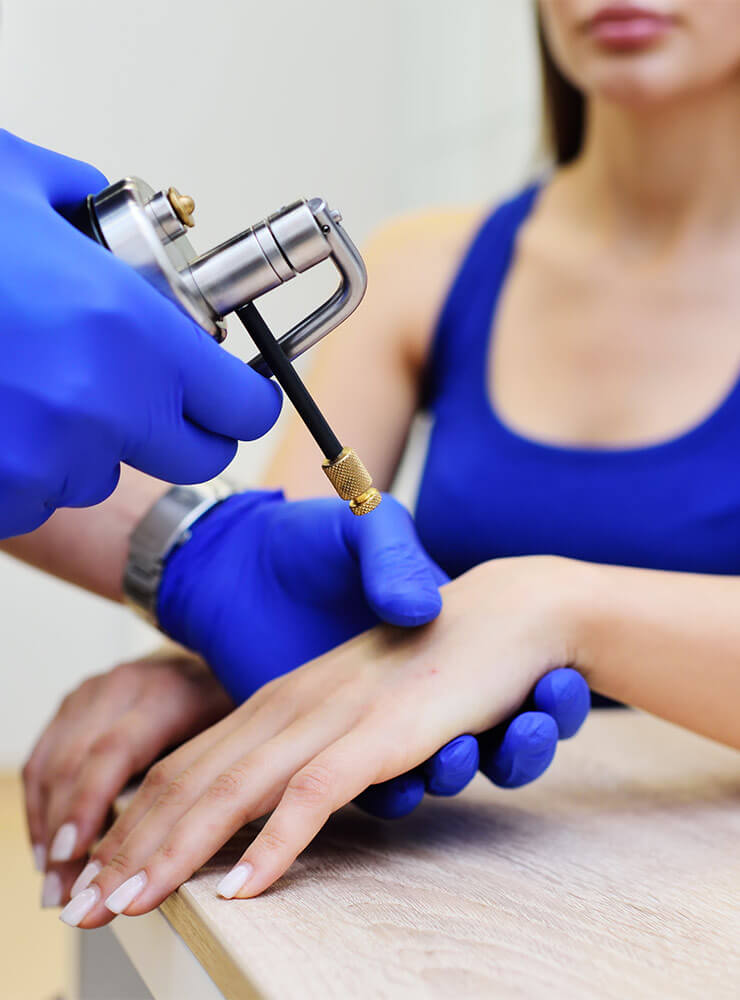 Cryotherapy skincare treatment being performed on a woman's hand using a cryopen.