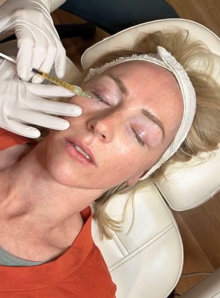 Woman having platelet rich plasma skin treatment at Dr Katey Cosmetics.